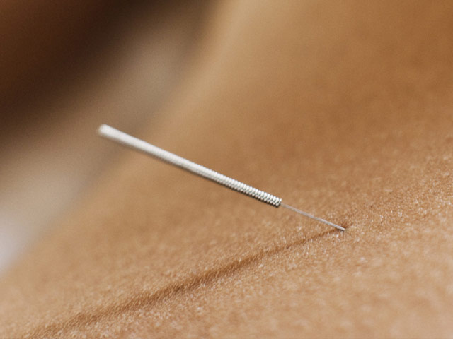 ALTERNATİF Konya akupunktur tedavisi,akupunktur kursu, manuel terapi konya, rukye tedavisi 